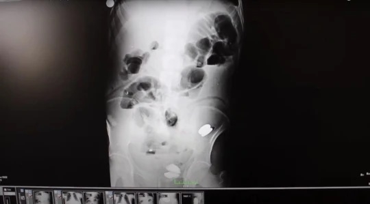 Bác sĩ kinh ngạc khi phát hiện 233 dị vật trong dạ dày của người đàn ông